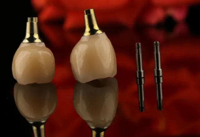 Couronnes transvissées sur implant avec leurs vis