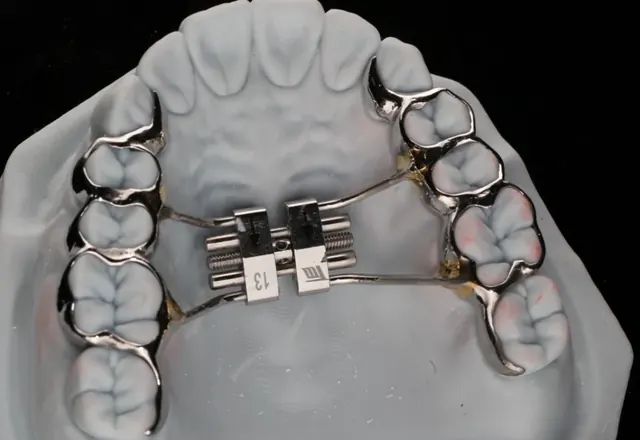 Disjoncteur orthodontique sur modèle